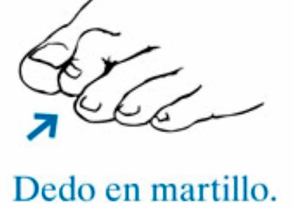 ¿Qué son los dedos en martillo?